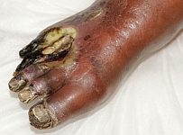picture_before_diabetic_foot_gangrene_02_august_2009