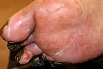 picture_before_diabetic_foot_gangrene_03_august_2009