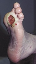 image_gangrene_toe_amputation_ulcer