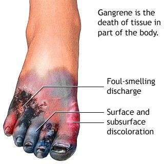 image_foot_gangrene_advanced